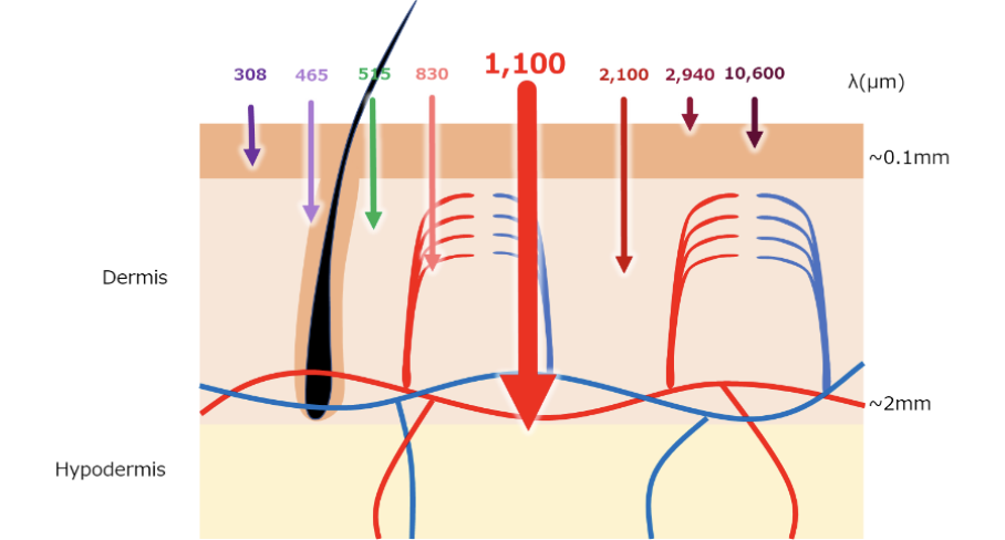 Illustration of skin layers with arrows showing light wavelengths from 308µm to 10,600µm penetrating the dermis and hypodermis. Black hair follicle and blue/red lines representing vascular structures are visible.